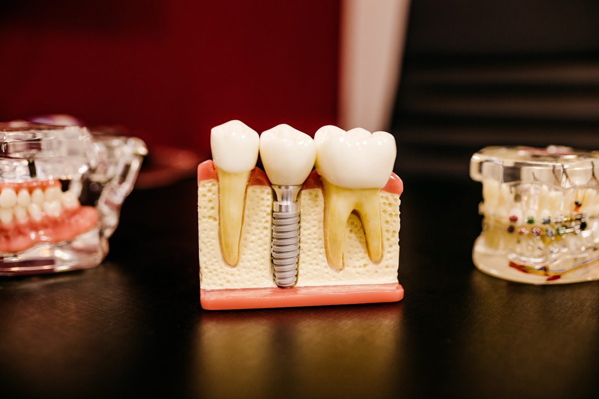 Modèle en coupe d'un implant dentaire intégré à la mâchoire